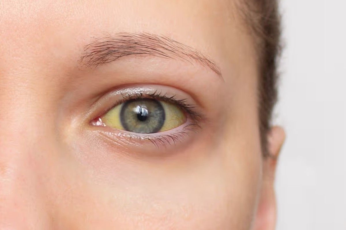 Cảnh báo 4 dấu hiệu của loại ung thư "sát thủ thầm lặng": Nếu có phải đi khám ngay