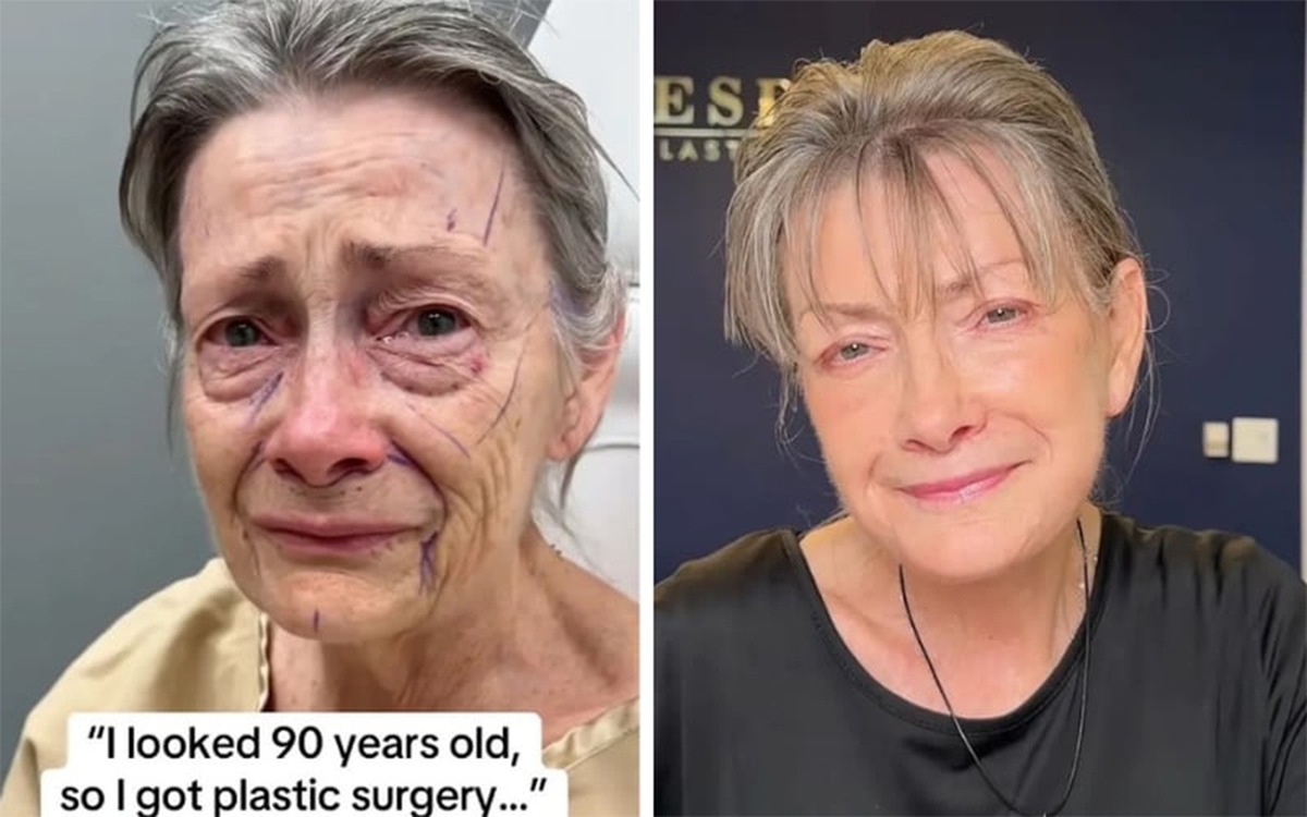 Cụ bà trông như 90 tuổi trẻ hóa kỳ diệu sau phẫu thuật căng da