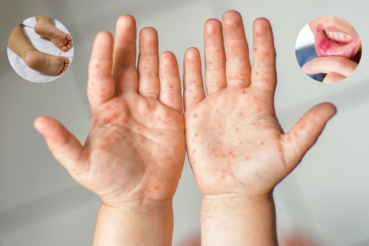 Bệnh dịch này đang gia tăng ở TP.HCM, hơn 8.000 ca mắc, 3 trẻ tử vong