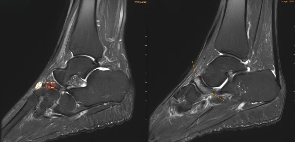 4 thói quen âm thầm “ăn mòn” xương ở người trên 40 tuổi