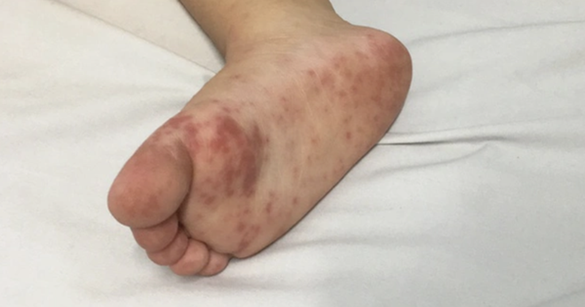 Dịch tay chân miệng “nóng” trở lại, trẻ nhỏ đối mặt nguy cơ biến chứng nặng