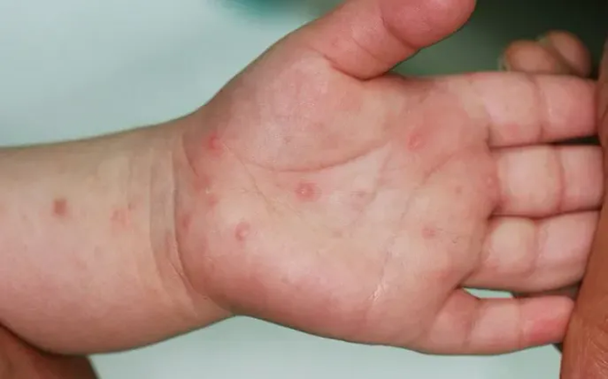 Bộ Y tế chỉ đạo khẩn tăng cường phòng, chống bệnh tay chân miệng