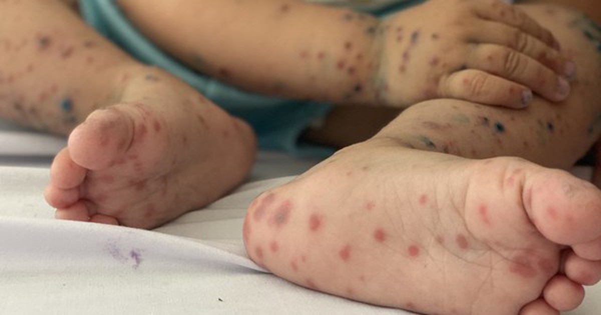 Tay chân miệng tăng mạnh, trẻ em chiếm hơn 99% ca mắc