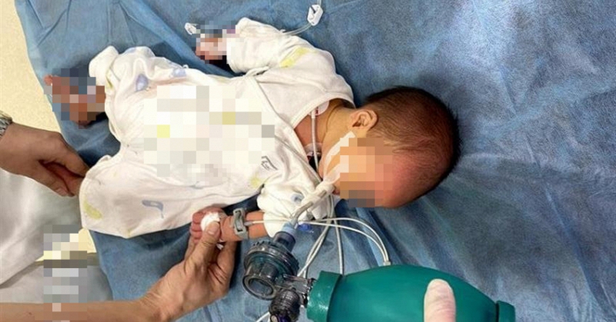 Em bé 52 ngày tuổi ngộ độc Botulinum nguy kịch vì loại nước chữa ho, bổ phổi rất quen từ bà ngoại