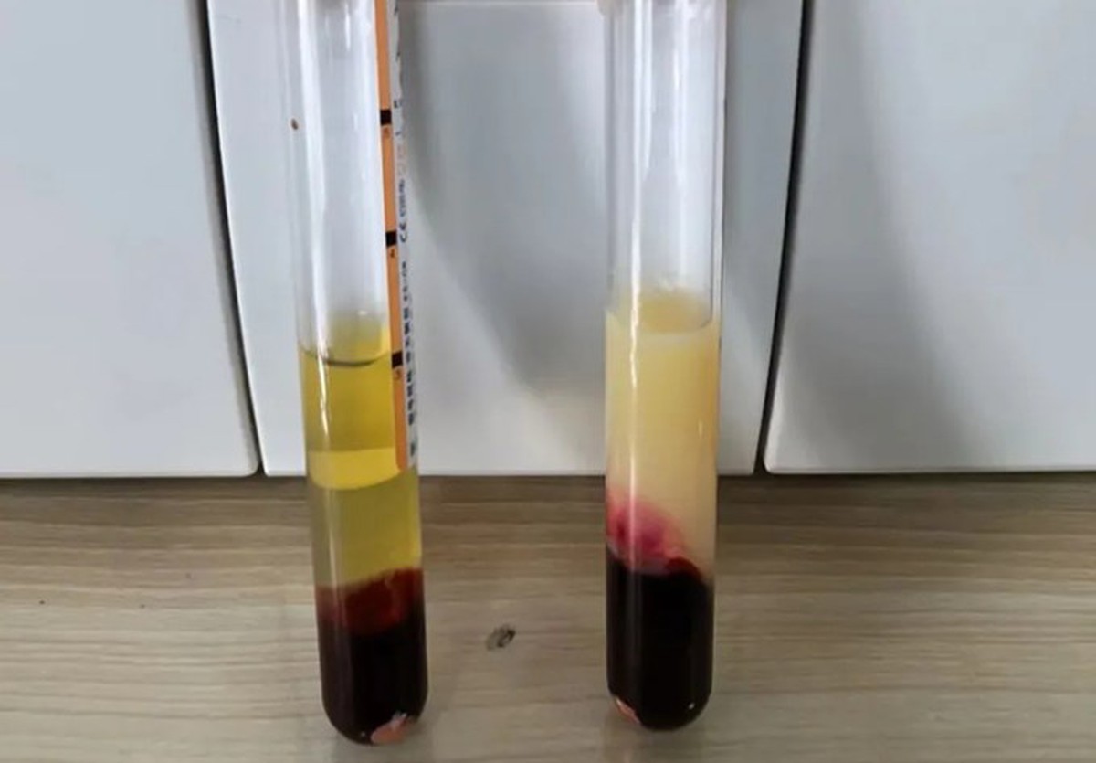 Vì sao tôi luôn kiểm soát mỡ máu nhưng khi khám lại vẫn không cải thiện, thậm chí bị nặng hơn?