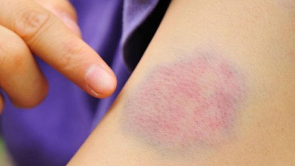 5 dấu hiệu nhỏ trên da "tố cáo" bệnh gan, nhiều người dễ xem thường