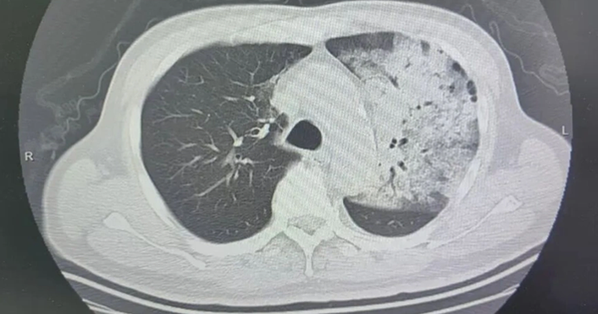 Người đàn ông sốt 40 độ C, phổi gần như "trắng xóa", chỉ vài ngày đã suy đa tạng: Thủ phạm liên quan đến thói quen nhiều gia đình vẫn mắc