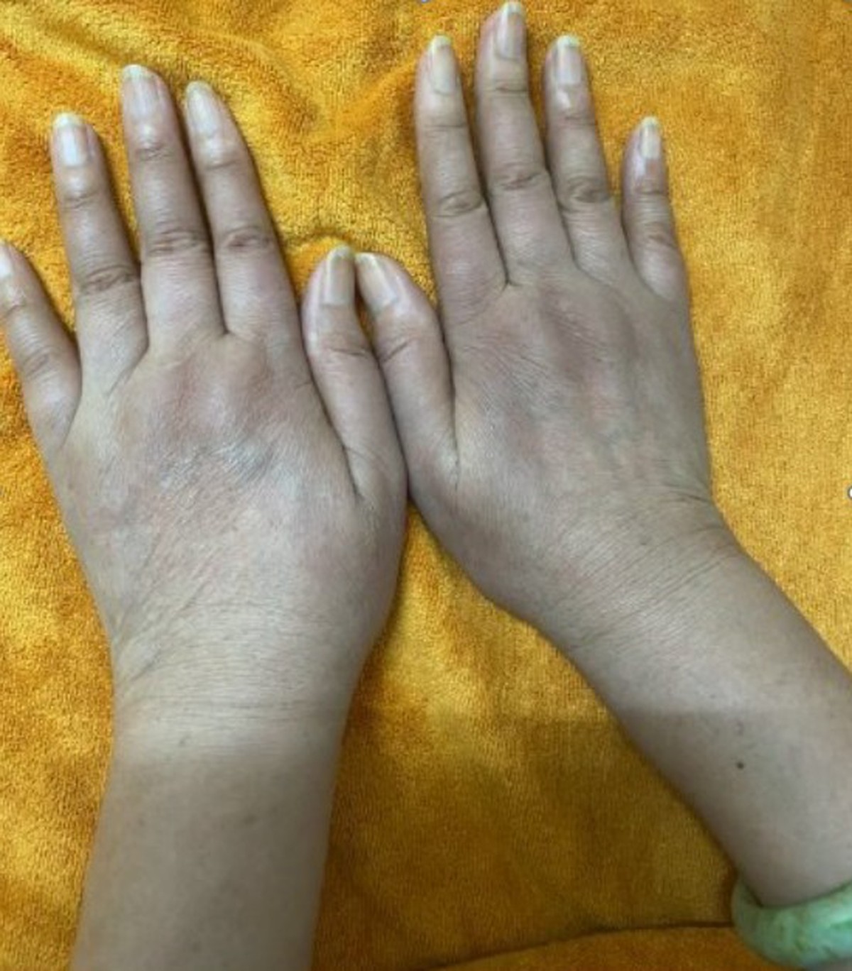 Nữ doanh nhân có 1 dấu hiệu lạ ở tay nhiều năm: Đi khám bác sĩ cảnh báo hàng loạt tạng đang "gặp nguy"