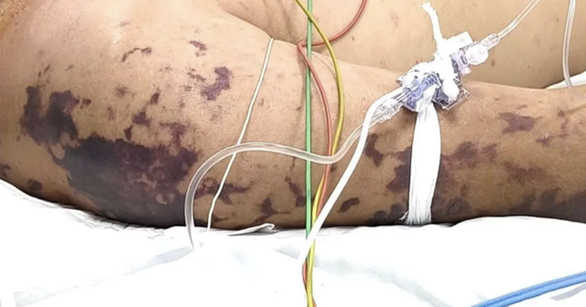 4 ca tử vong do não mô cầu, Bộ Y tế cảnh báo nguy cơ