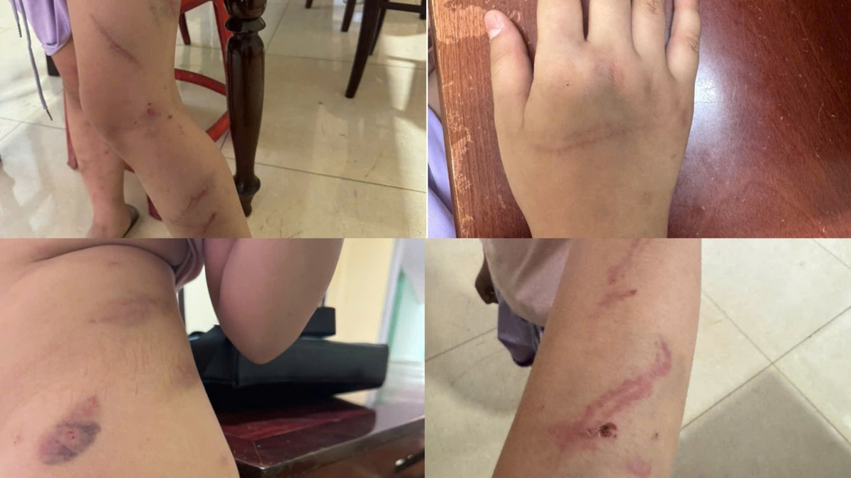 Xác minh vụ bé gái 9 tuổi có 34 vết bầm nghi bị bạo hành ở Đắk Lắk