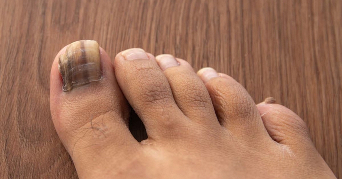 Dấu hiệu ở móng chân cảnh báo loại ung thư nguy hiểm: Nhiều người bỏ qua, bác sĩ khẩn thiết nhắc nhở
