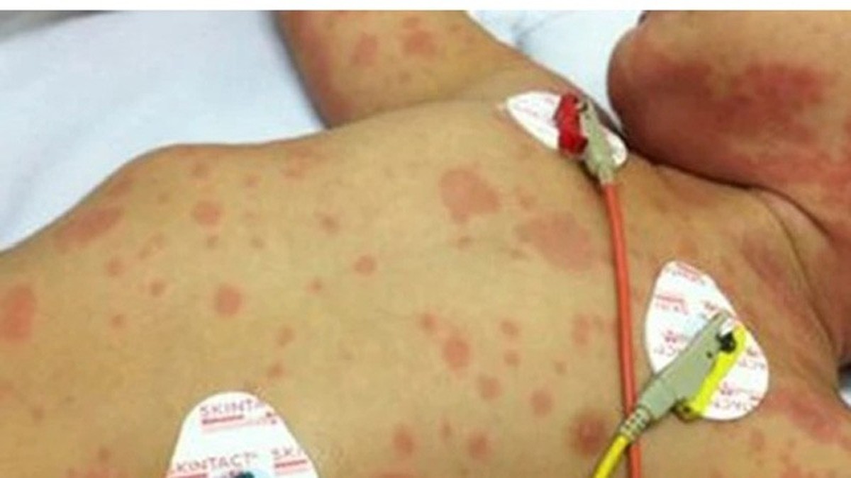 Ca bệnh do "sát thủ 24 giờ" não mô cầu gia tăng: Bác sĩ Bệnh viện Bạch Mai cảnh báo người lớn tuyệt đối không làm 1 việc khi ở gần trẻ