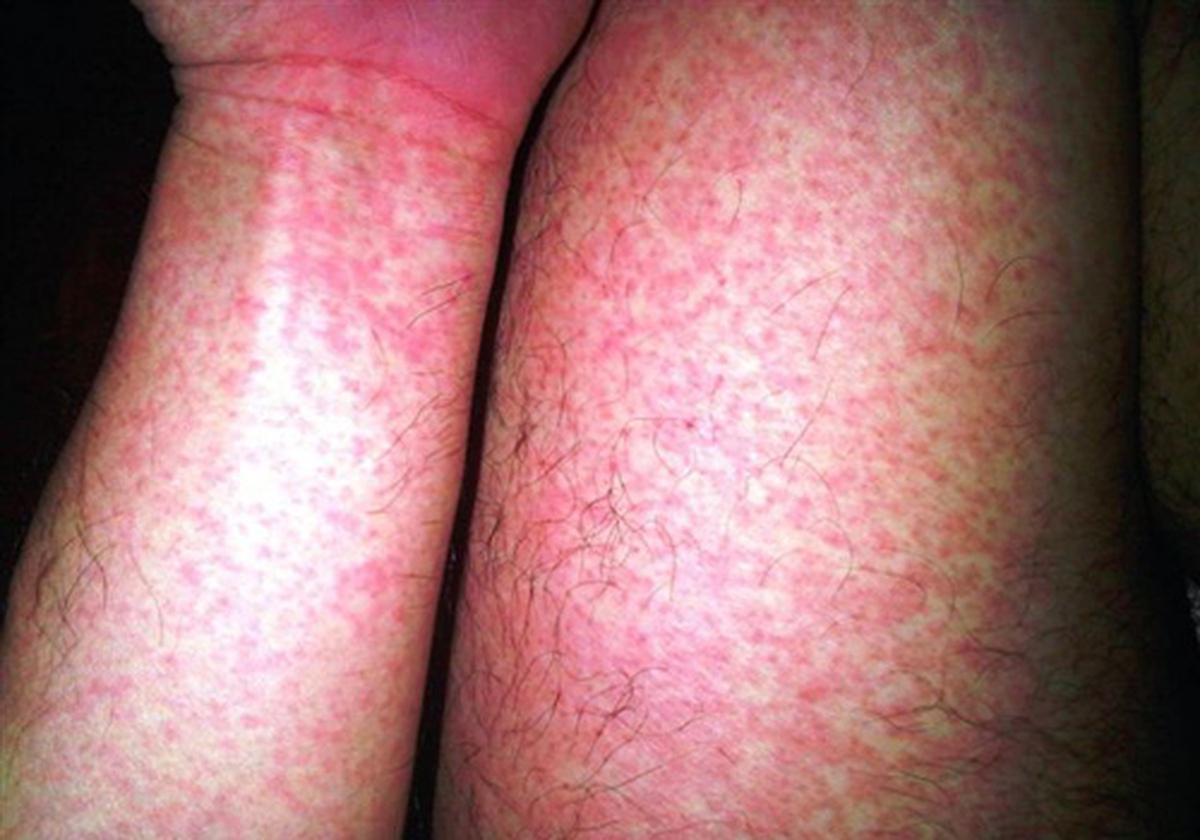 Gần 32.000 ca mắc, 4 ca tử vong: Bệnh viện Bạch Mai phát cảnh báo về 1 căn bệnh đang tăng nhanh, có thể suy đa tạng chỉ trong vài ngày