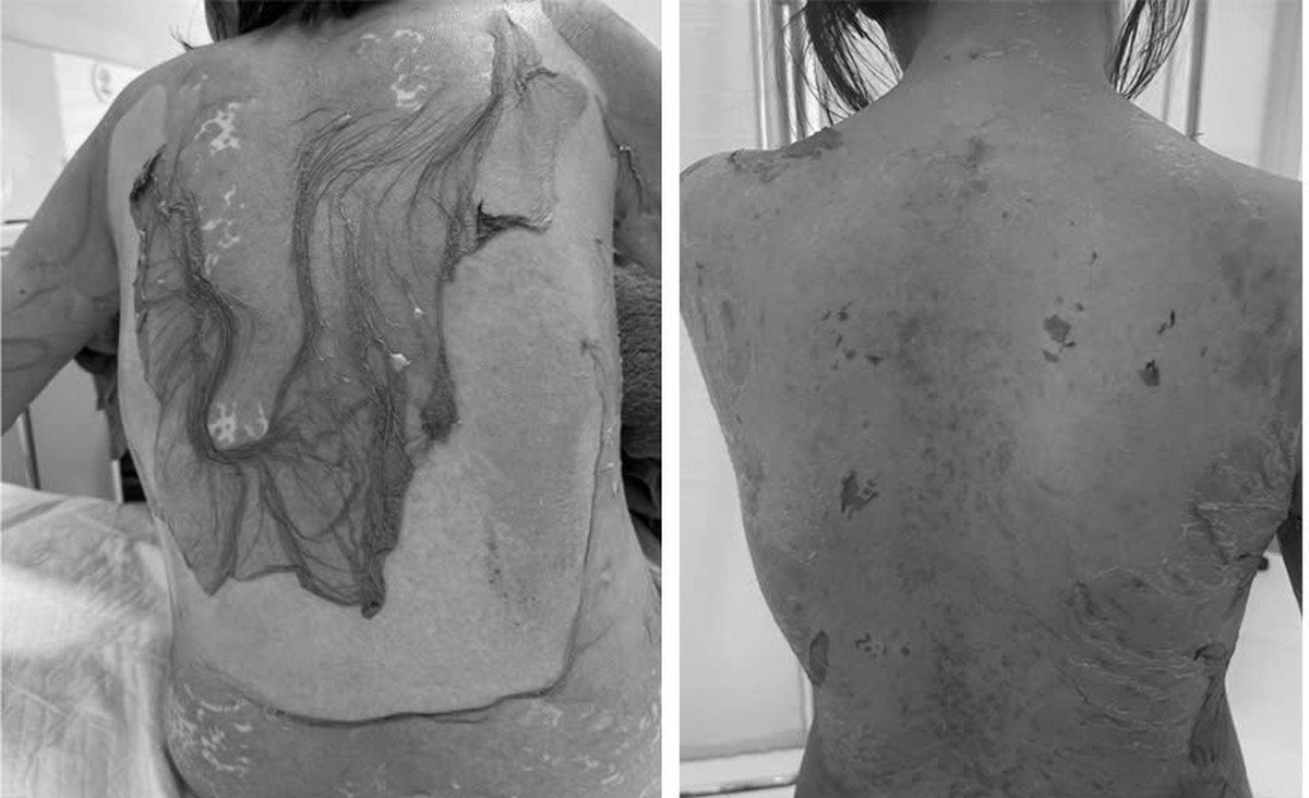 Hải Phòng: 1 phụ nữ 35 tuổi bị tróc da như "cua lột" vì thói quen dùng thuốc cực kỳ phổ biến