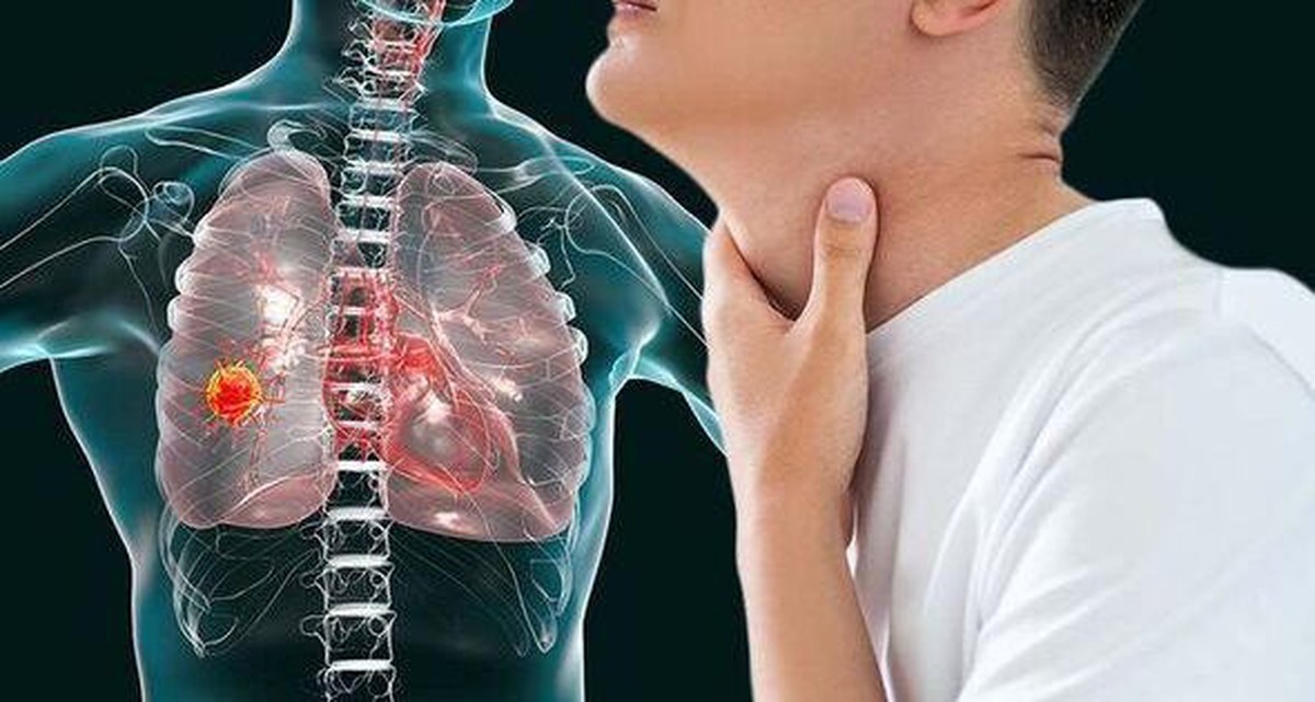 Không phải ho dai dẳng: 5 DẤU HIỆU cảnh báo ung thư phổi nhiều người vẫn lầm tưởng là bình thường
