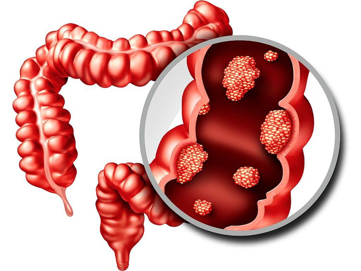 6 dấu hiệu cảnh báo đỏ của "căn bệnh ung thư đáng sợ": Có 1 cũng cần đi khám ngay!