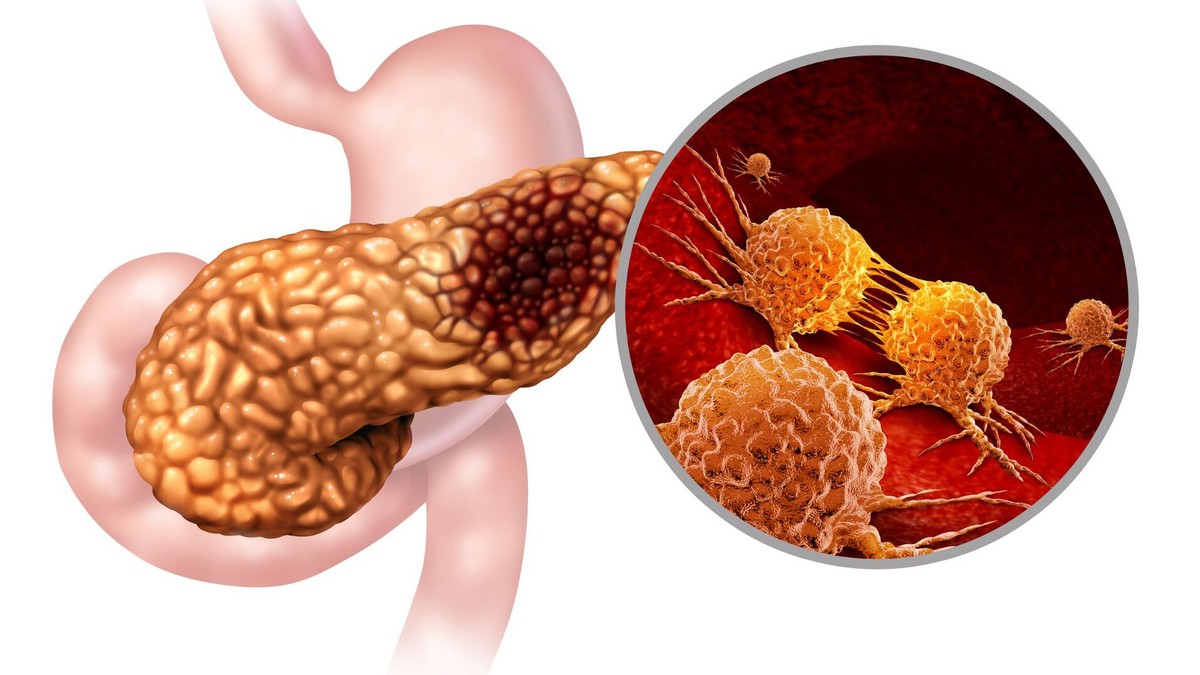 3 người trong 1 nhà đều mắc ung thư tuyến tụy: Bất ngờ với "thủ phạm"