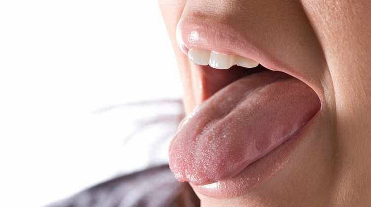 Cứ nghĩ nhiệt miệng, người đàn ông 41 tuổi "mất" nửa chiếc lưỡi sau 2 tháng