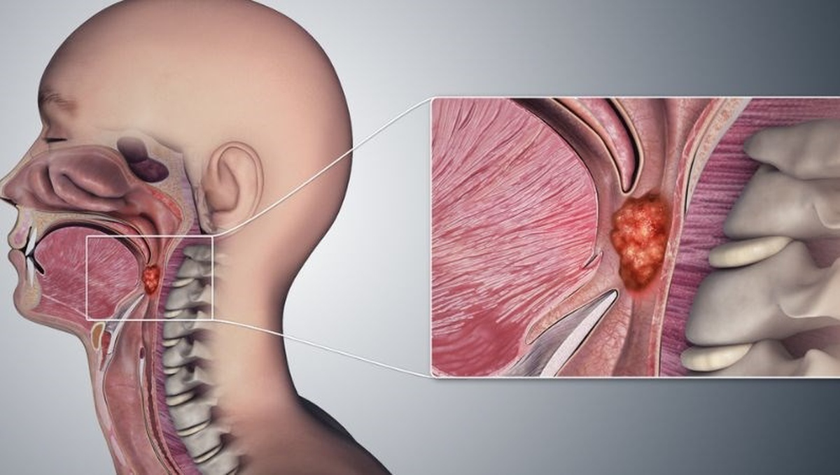 Nghẹt mũi tưởng viêm xoang, sau 3 tháng người đàn ông 33 tuổi phát hiện mắc ung thư giai đoạn cuối: 3 dấu hiệu quen thuộc khiến nhiều người chủ quan!