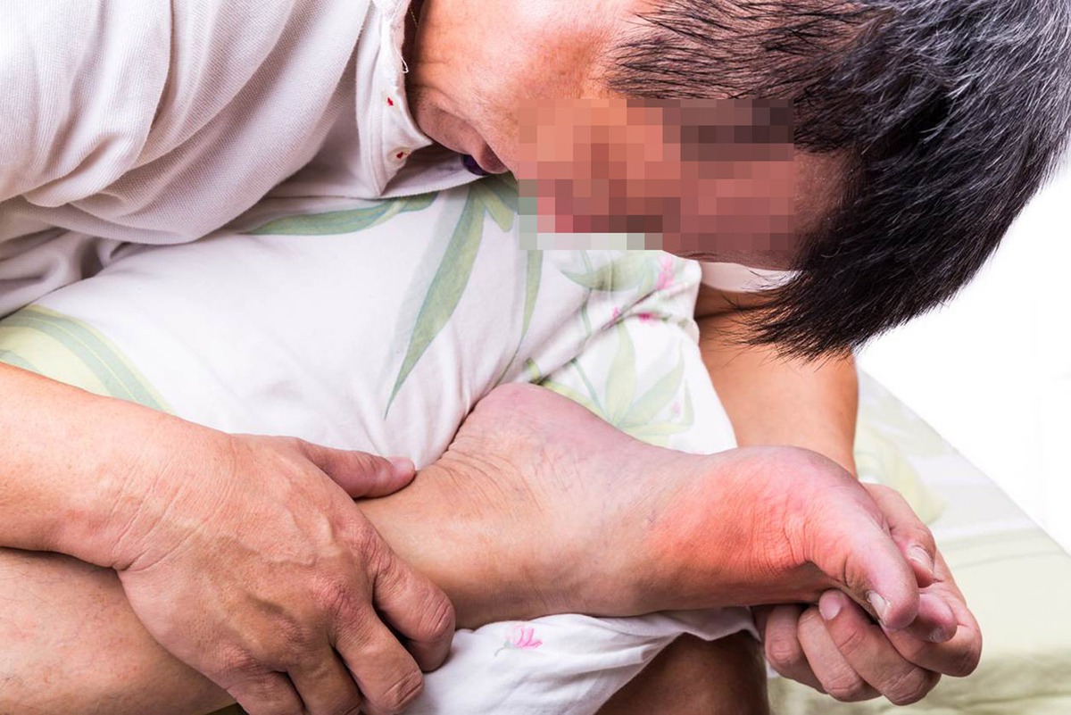 Cứ nghĩ bong gân nên tự xoa bóp, người đàn ông 38 tuổi ngỡ ngàng khi biết bị gout