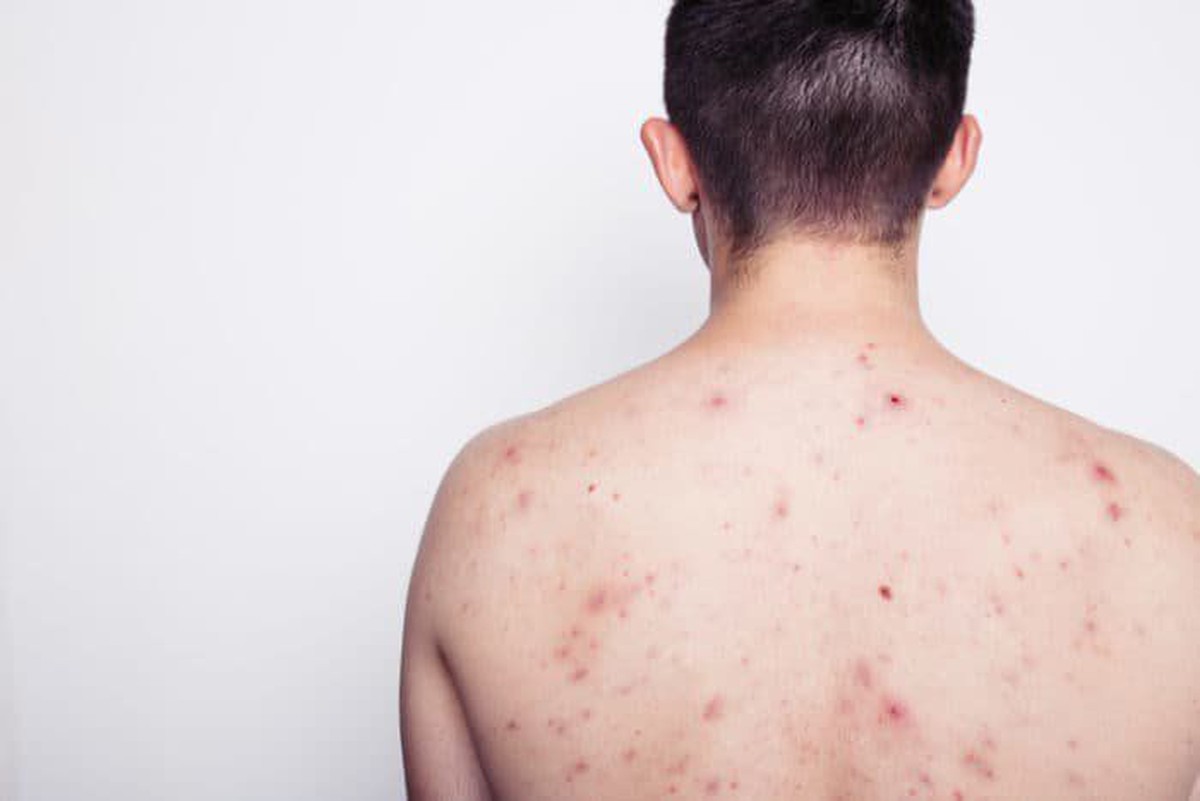 Nam thanh niên 23 tuổi nhiễm HIV sau khi tham gia lễ hội té nước tại Thái Lan