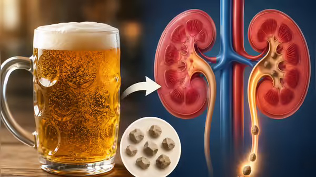 Uống bia giúp đào thải sỏi thận?