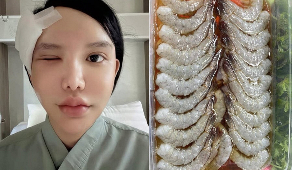 Người phụ nữ bị ký sinh trùng bò vào hốc mắt, suýt mù, bác sĩ cảnh báo 1 thói quen nhiều người Việt mắc phải