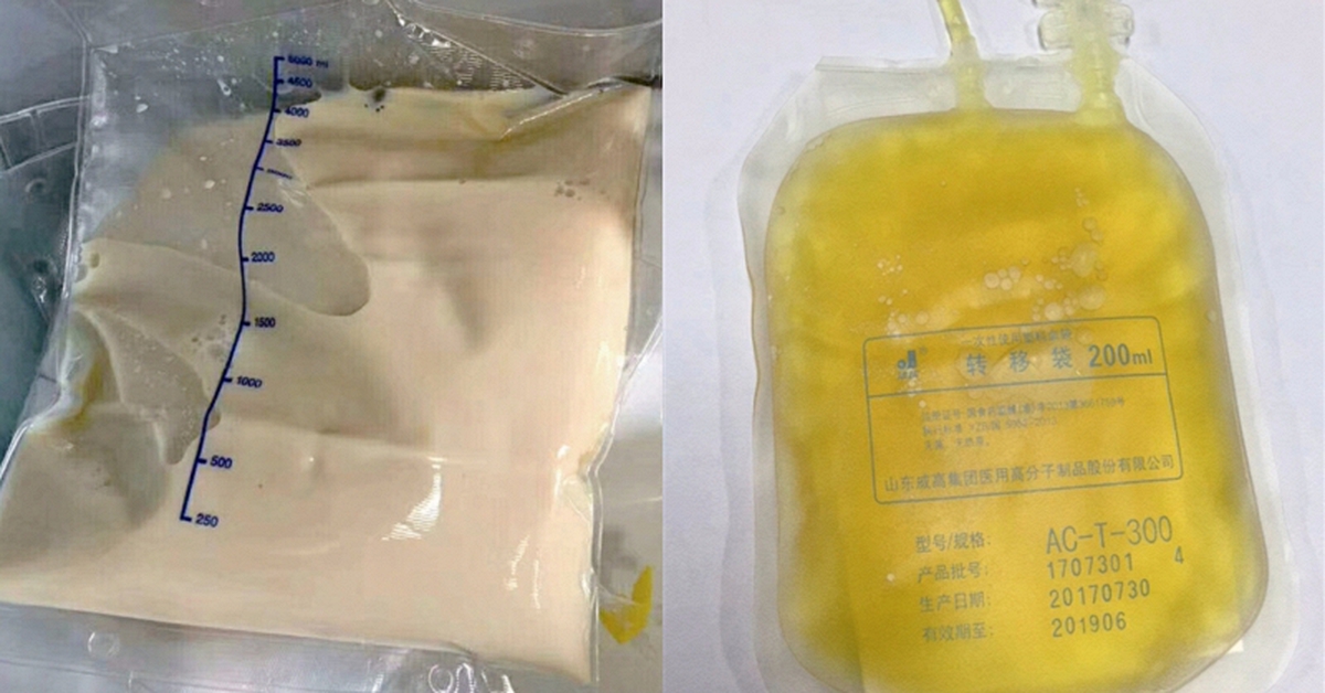 Cô gái 27 tuổi máu đục như trà sữa và "nhiều dầu" vì kiểu ăn tiện lợi của nhiều người Việt trẻ