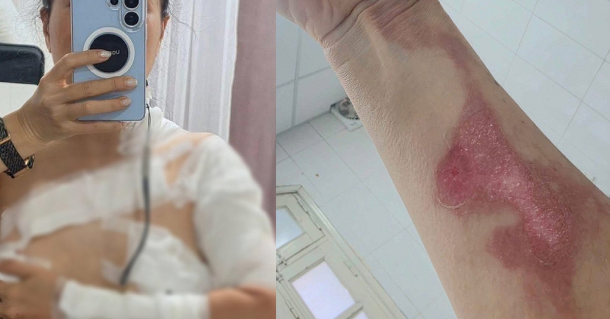 Đi gội đầu dưỡng sinh, cô gái nhận "combo sự cố": Bỏng độ 2, tự đi cấp cứu vì nồi xông hơi phát nổ?
