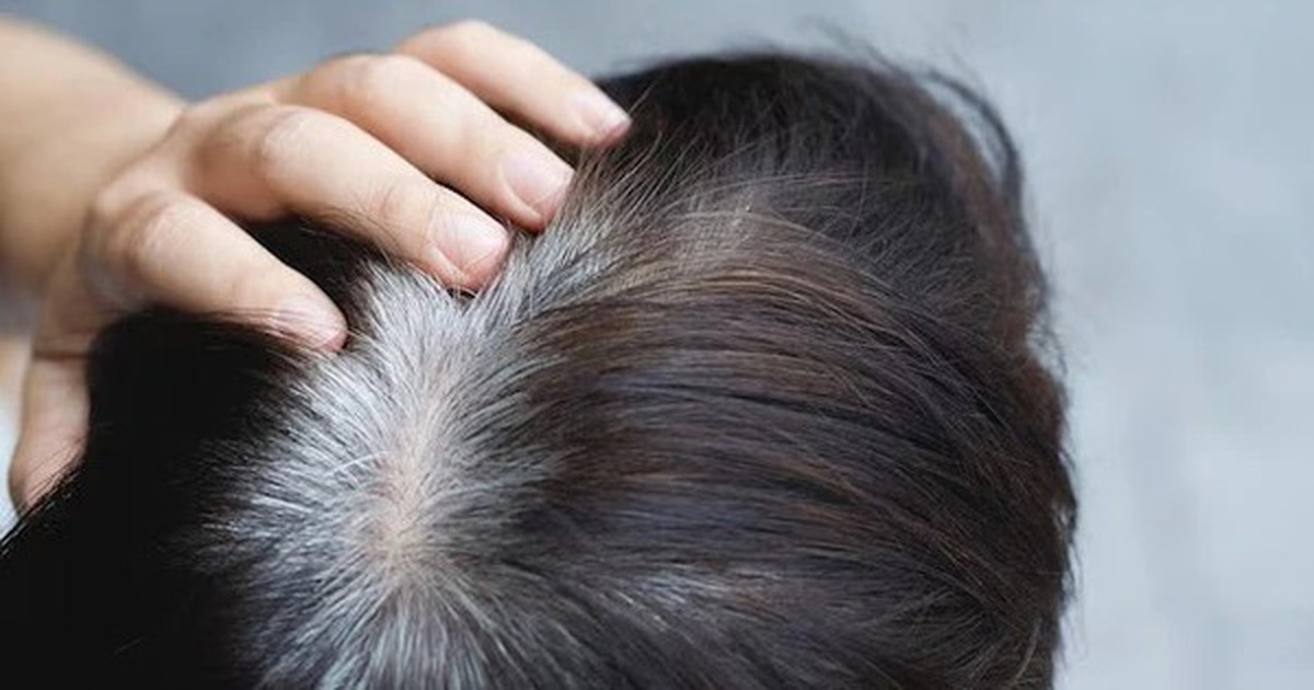 Người trẻ tóc bạc sớm: Bác sĩ chỉ ra 3 dưỡng chất hay bị thiếu hụt, ít người để ý đến