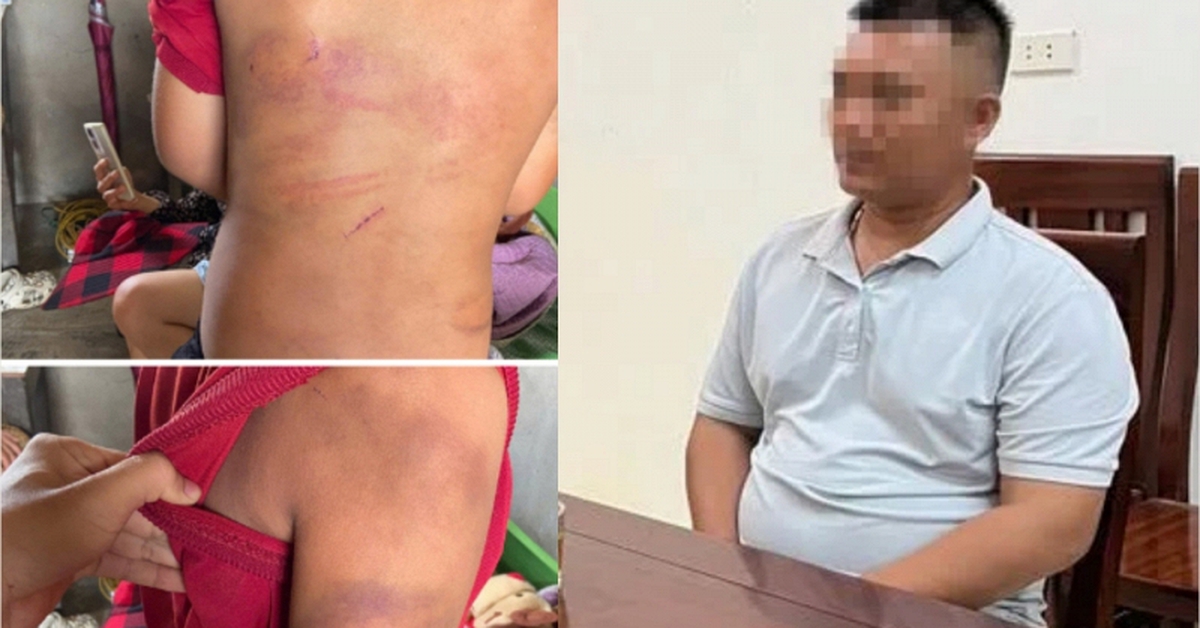 Vụ bé trai 10 tuổi người thâm tím nghi bị bạo hành: Lời khai của bố đẻ