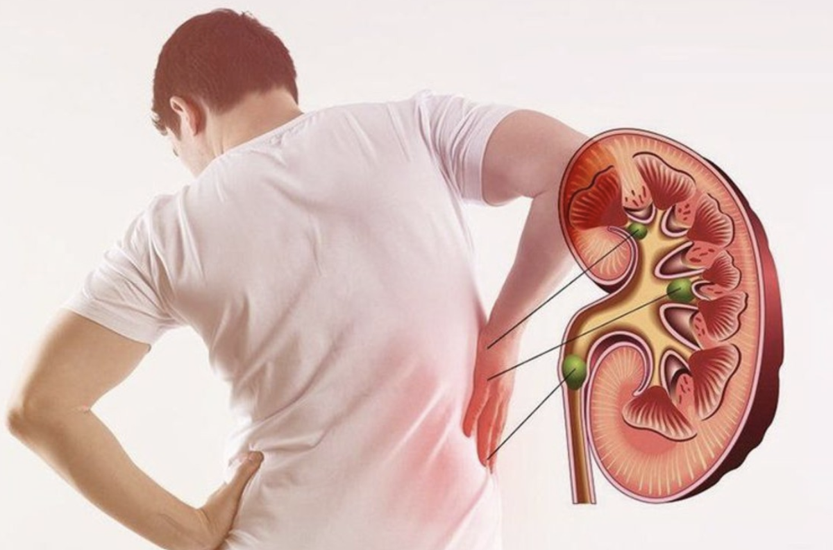 Bác sĩ cảnh báo: Xuất hiện 5 BIỂU HIỆN này có thể là dấu hiệu suy thận, nhiều người nhầm với đau lưng thông thường