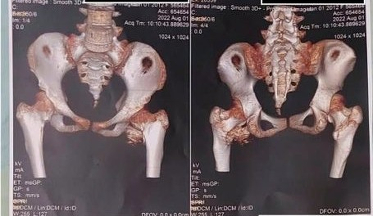Bé gái 12 tuổi mắc "hội chứng người hóa đá" hiếm gặp, bố mẹ ngỡ ngàng khi bác sĩ nhắc tới cú ngã xe đạp 2 năm trước