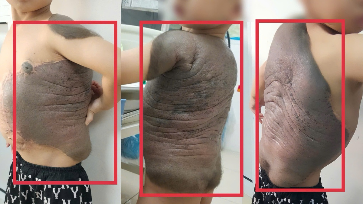 Bé trai Hà Nội mang khối u khổng lồ như "mai rùa" đến gặp bác sĩ: Sau 7 năm lần đầu tiên đứng thẳng như bao bạn bè trang lứa