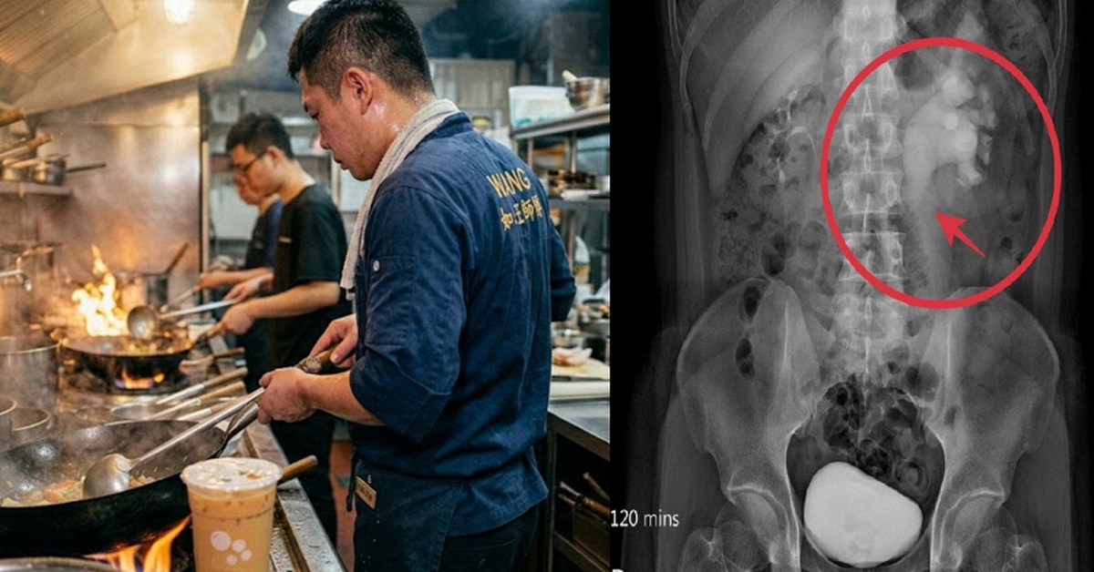 Nam đầu bếp 32 tuổi phù thận cấp tính vì 1 thói quen uống nước không ít người vẫn làm mỗi ngày