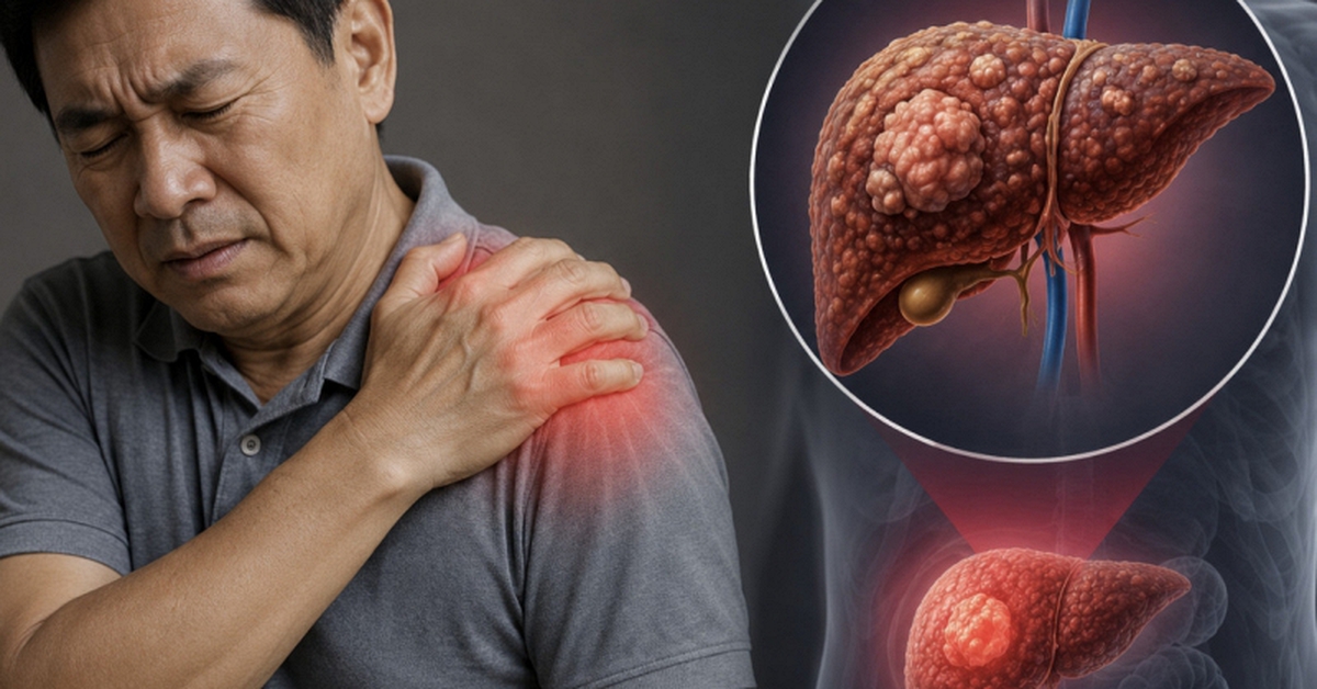 Cảnh báo 1 TÍN HIỆU cực quan trọng của ung thư gan: Nhiều người còn cố cãi chỉ đau vai thông thường