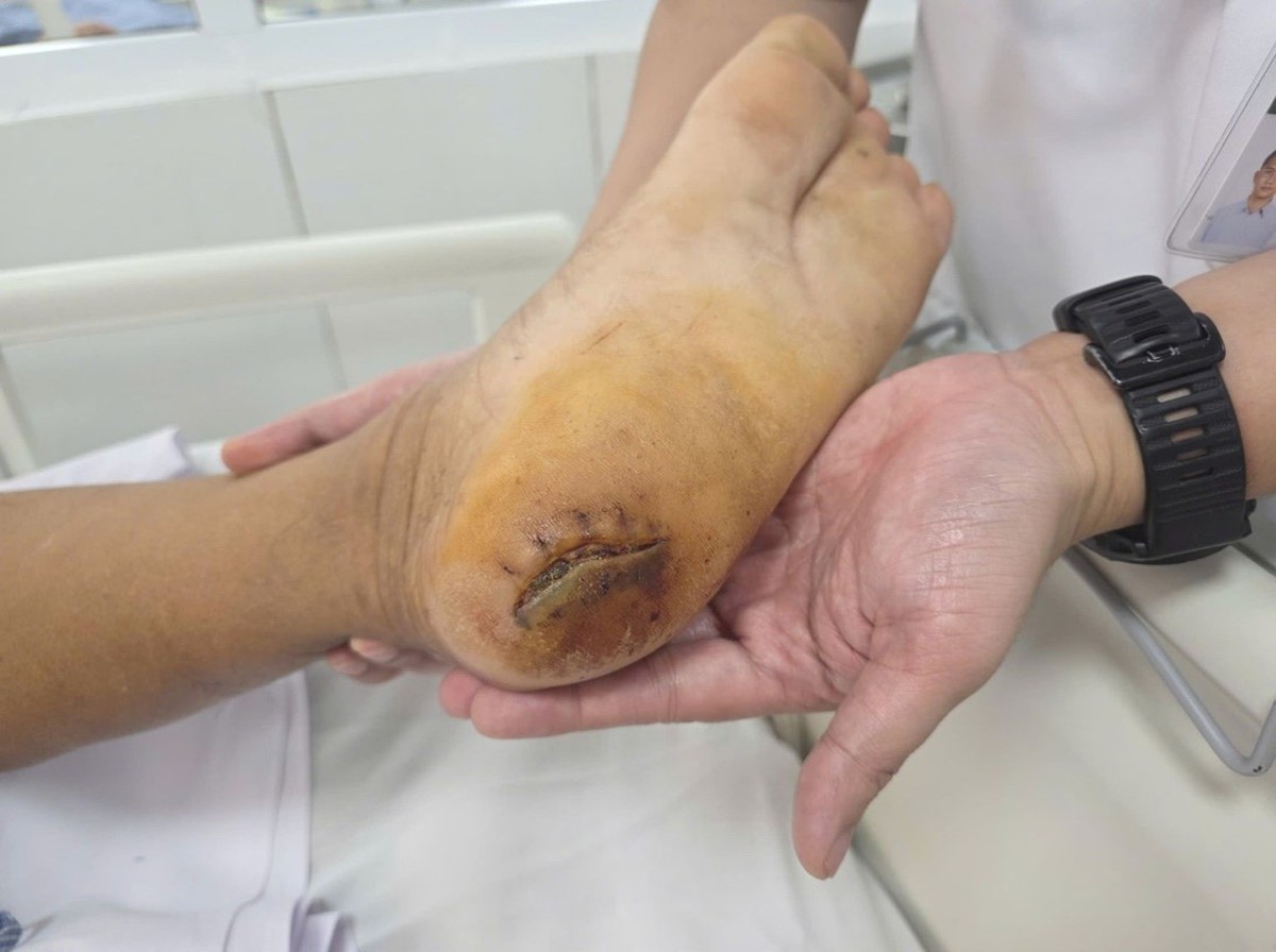 Bệnh viện Bạch Mai cảnh báo: Nhiều người đang phải nhập viện thở máy vì 1 căn bệnh do chủ quan vết thương nhỏ