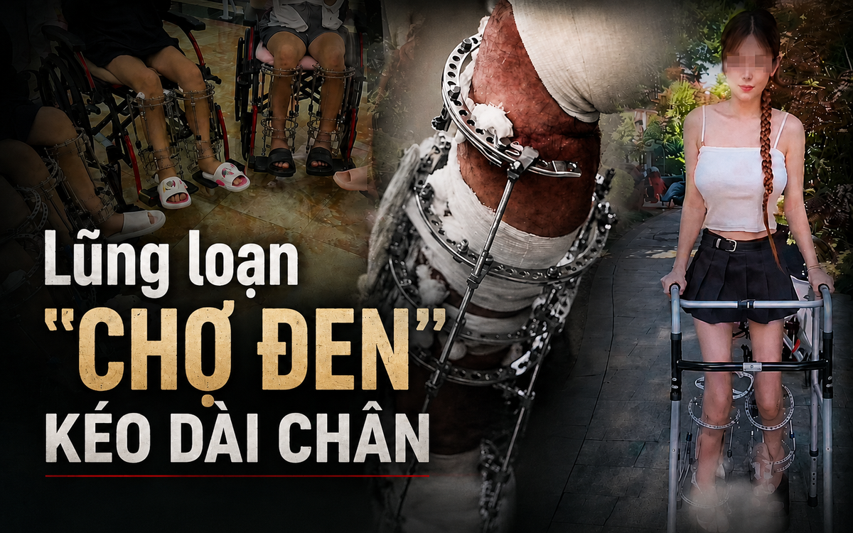 Điều tra: Bên trong "chợ đen" phẫu thuật tăng chiều cao, hơn 1,5 tỷ đồng đổi lấy từng milimét và những ca mổ không lộ mặt bác sĩ