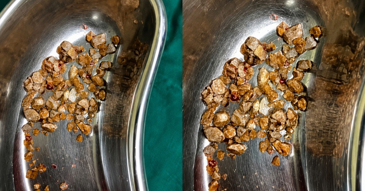 Nam kỹ sư 35 tuổi nhập viện vì sỏi chất đầy thận sau khi bỏ trà sữa, uống thứ nước lành mạnh để giảm cân