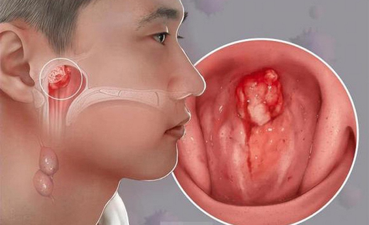 Con bị ù tai thôi mà... và cú sốc của gia đình khi bé trai 14 tuổi được chẩn đoán ung thư giai đoạn tiến triển
