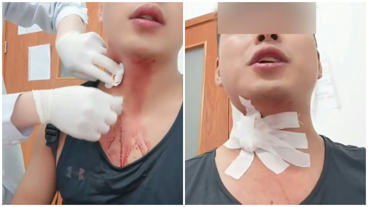 Khó tin: Nhập viện do vỡ tĩnh mạch sau khi cố đập... muỗi