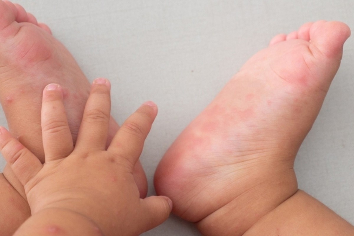 Ca mắc tay chân miệng tăng, chuyên gia khuyến cáo "3 sạch" để phòng bệnh
