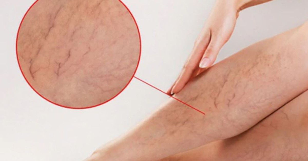 Tưởng mỏi chân do đứng bán hàng, đi khám phát hiện tĩnh mạch hiển suy nặng