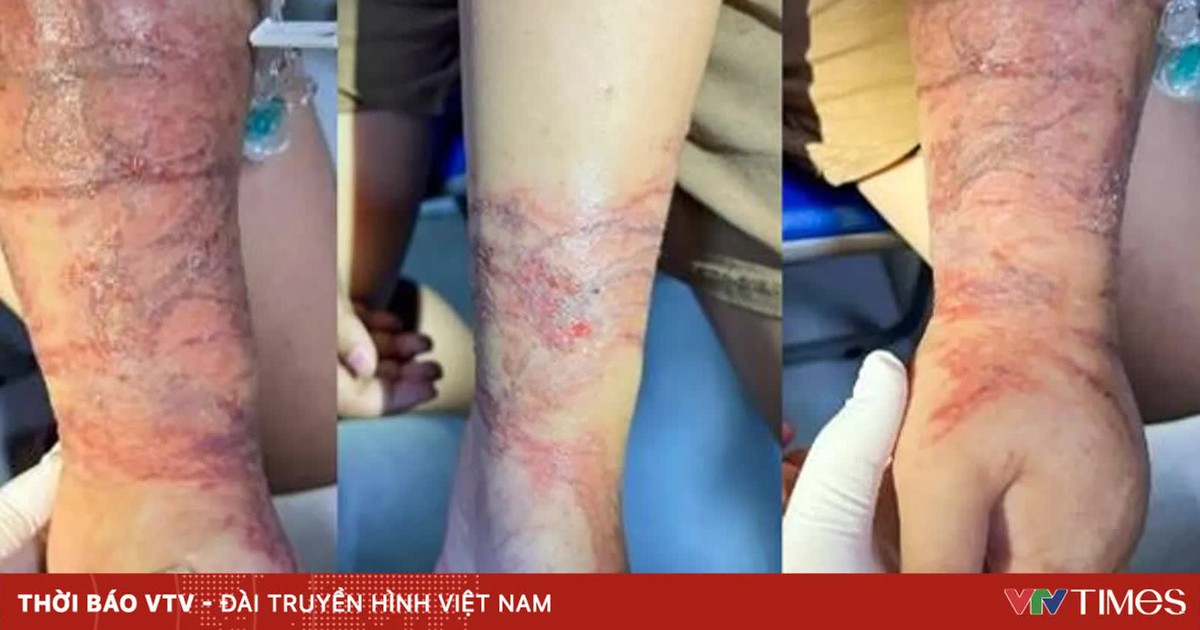 Cảnh giác sứa đốt khi tắm biển