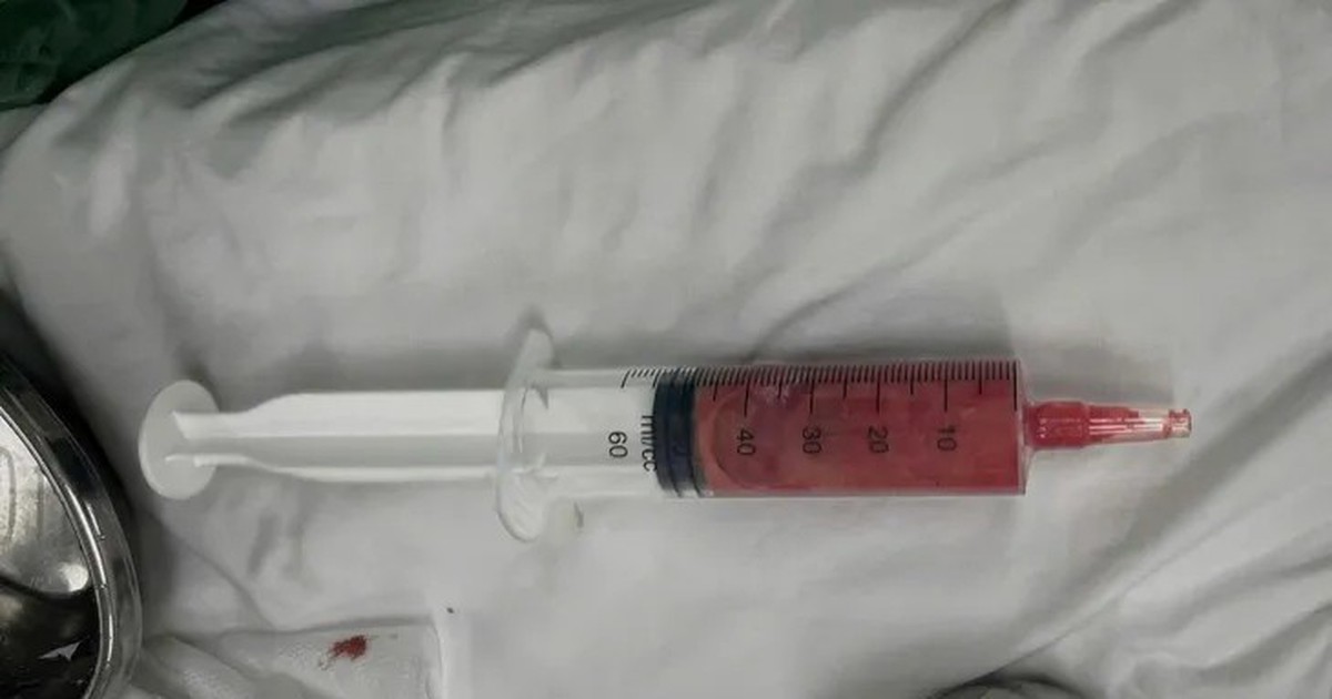 Bệnh viện Trung ương Quân đội 108 cảnh báo những người tiêm filler 5-10 năm trước