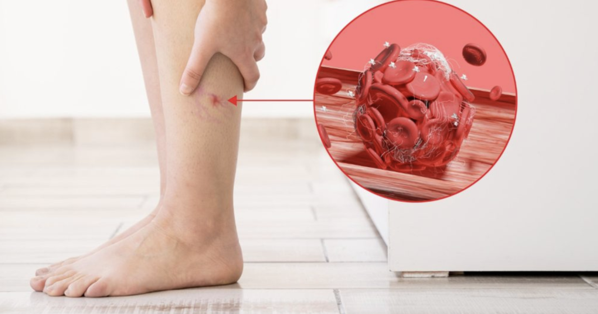 Bất kể giới tính, nếu điều này xuất hiện trên chân, đó có thể là dấu hiệu của cục máu đông trong cơ thể