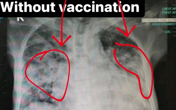 4 bức ảnh chụp phổi của bệnh nhân Covid-19 đã tiêm các loại vắc xin khác nhau và không tiêm: Kết quả gây sốc!