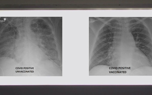 So sánh ảnh chụp phổi của bệnh nhân COVID-19 đã tiêm và chưa tiêm vaccine, phát hiện điều kinh ngạc - Vimarsana News