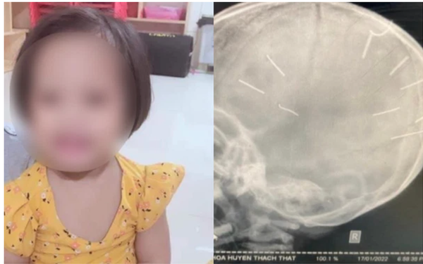 Vụ bé 3 tuổi có 9 dị vật giống đinh găm vào đầu: Cảnh sát hình sự Hà Nội vào cuộc điều tra
