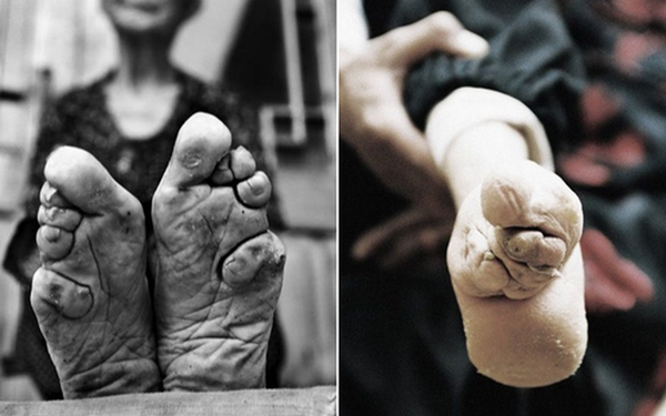 Hình ảnh của những đôi chân gót sen cuối cùng tại Trung Quốc: Nhân chứng sống ám ảnh về hủ tục đau thương bậc nhất thời phong kiến